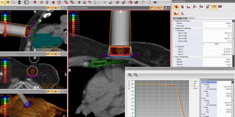 The Provincial Hospital of Castellón has taken up radiance, the world’s only radiosurgery planner