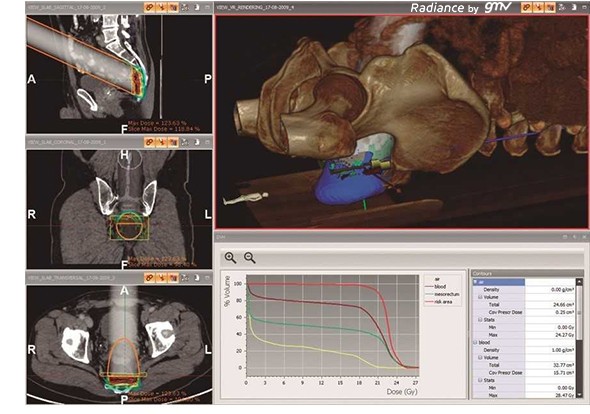 Intraoperative radiotherapy, a great advance for the treatment of colorectal cancer