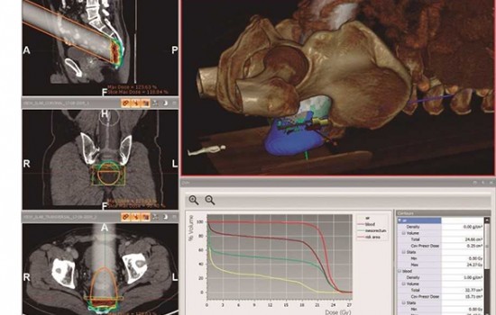 Intraoperative radiotherapy, a great advance for the treatment of colorectal cancer